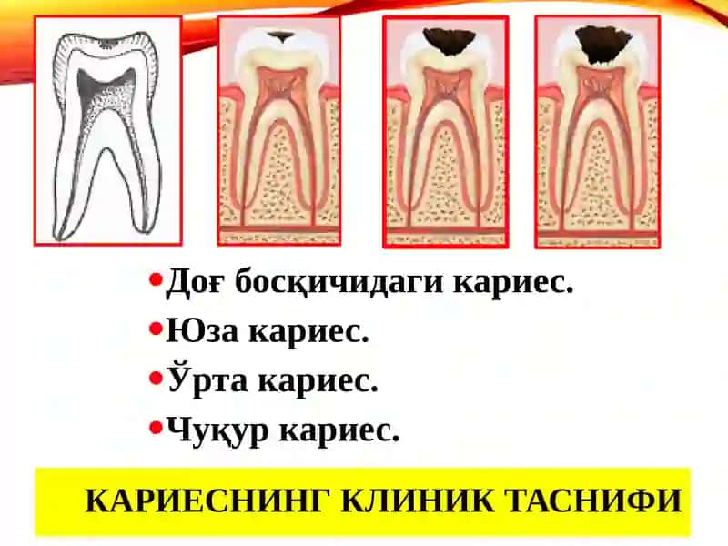 Кариес касаллигини даволаш 2