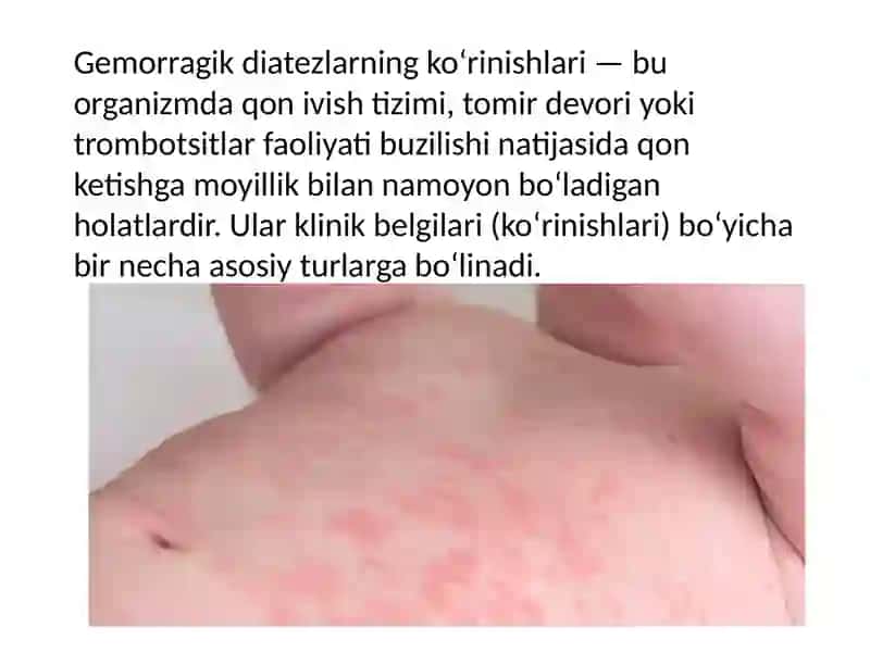 Gemorragik diatezlarning ko‘rinishlari 2