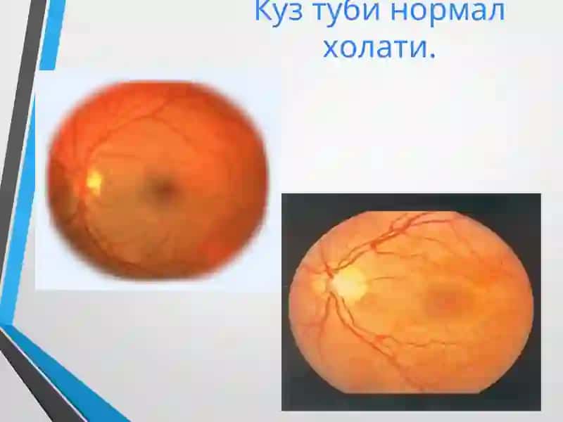 Атеросклероз 2