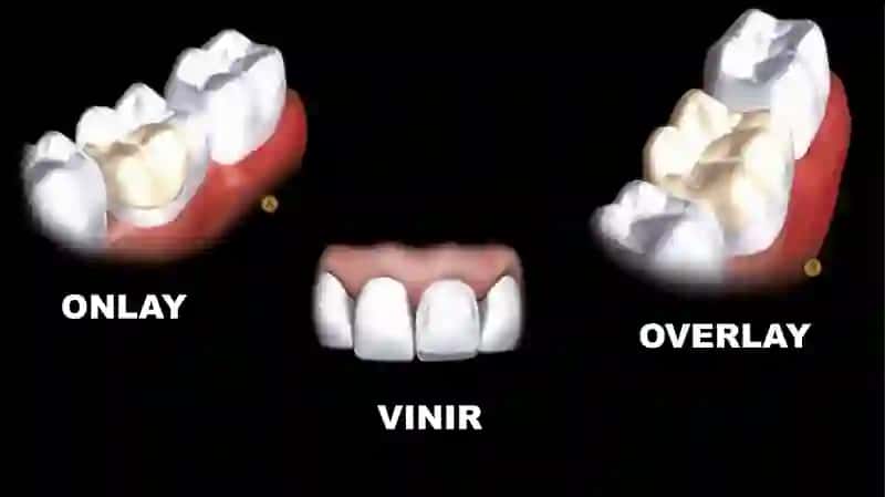 Ortopediyada tishlarni ustup bilan charxlash 2