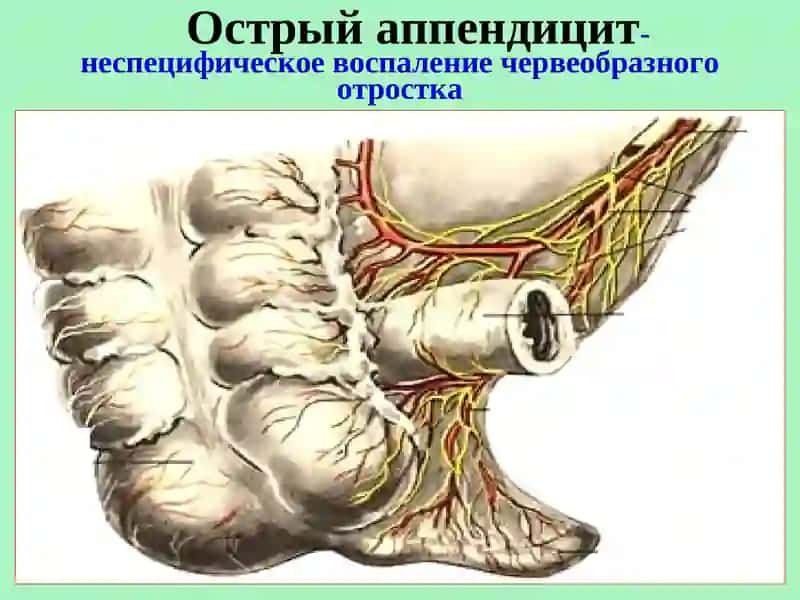 Острый аппендицит 2