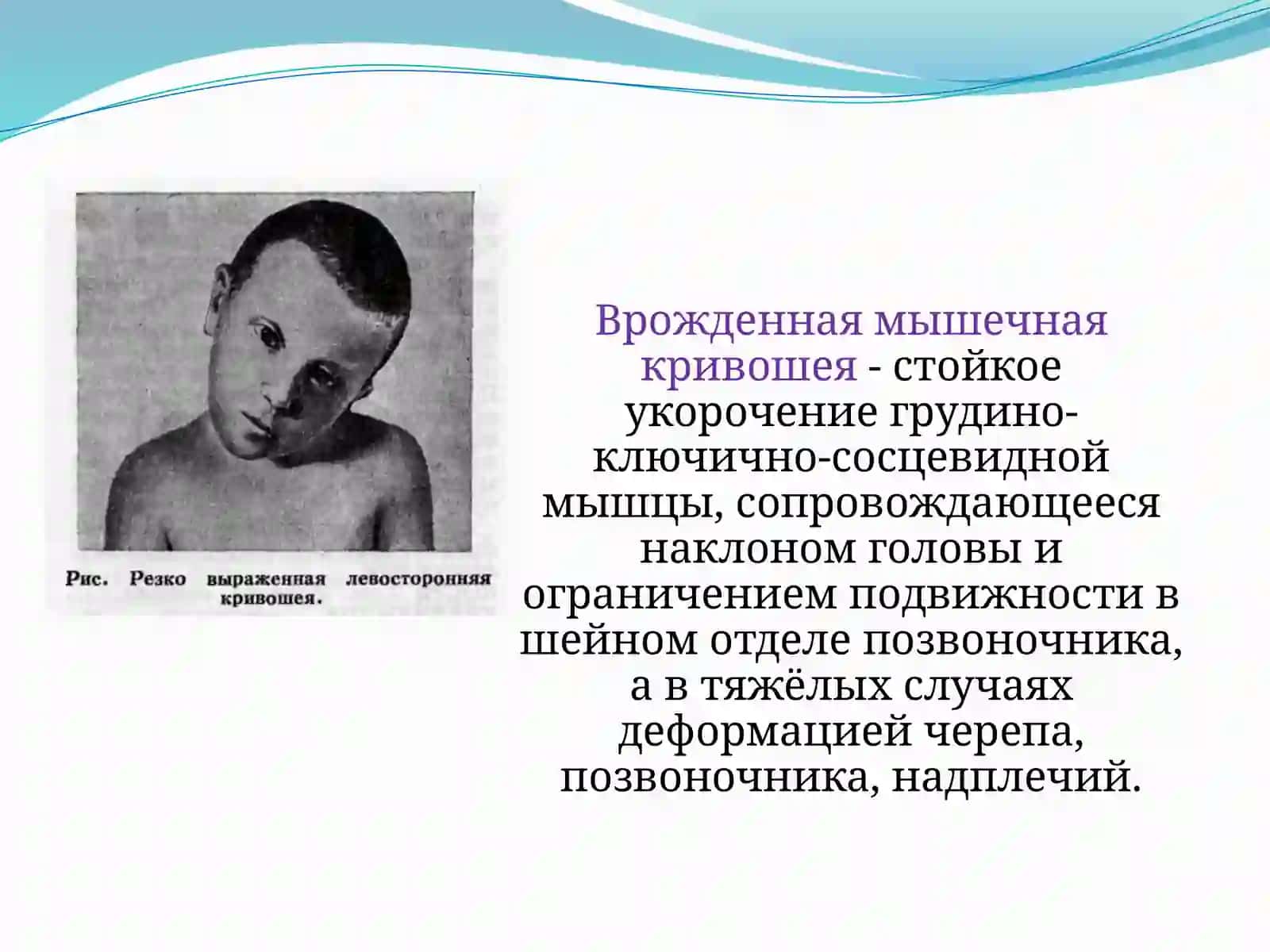 Врожденная мышечная кривошея 2