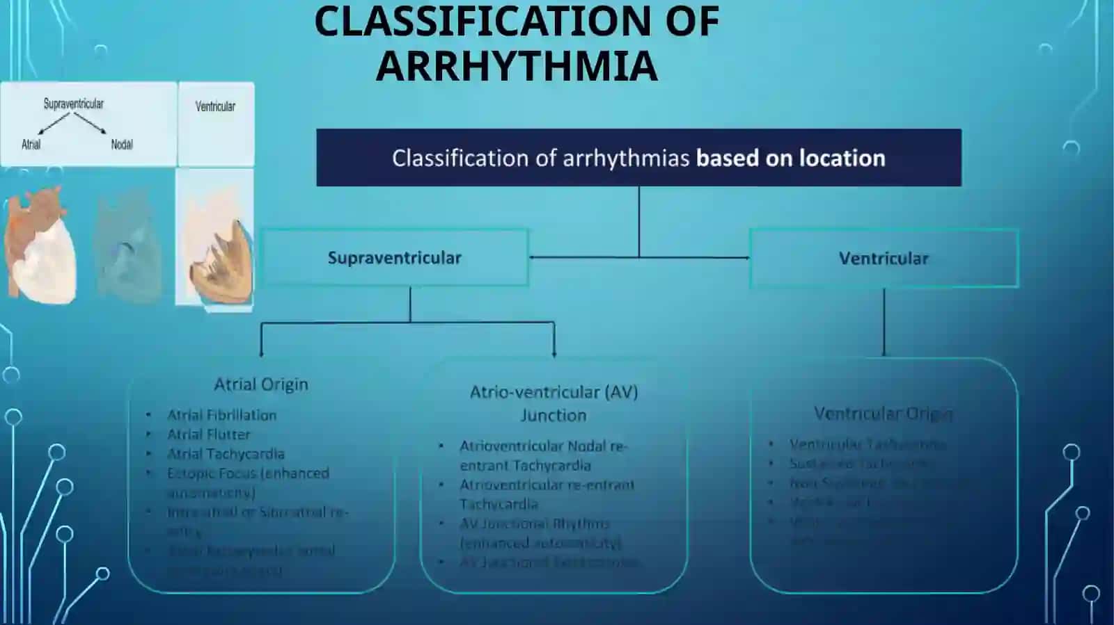 Supraventricular arrhythmia 2
