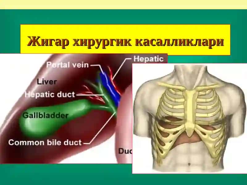Жигар хирургик касалликлари 2