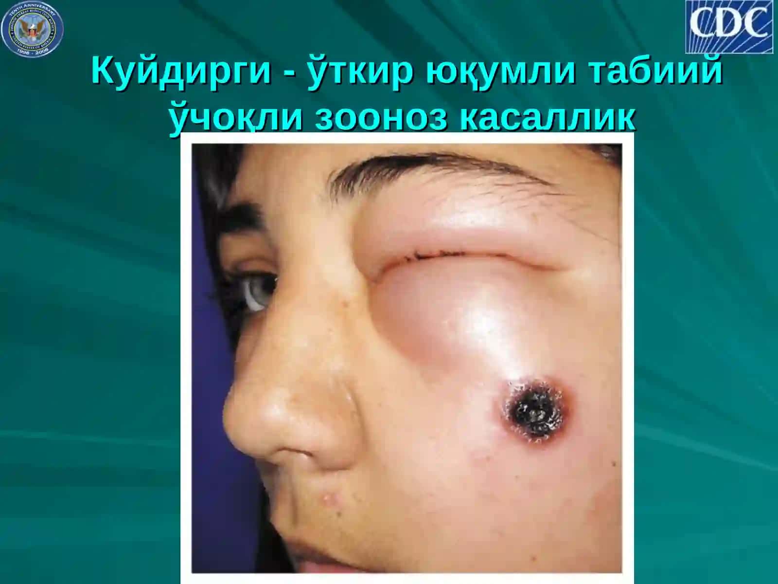 Куйдирги (сибир яраси, ёмон сифатли карбункул) 2