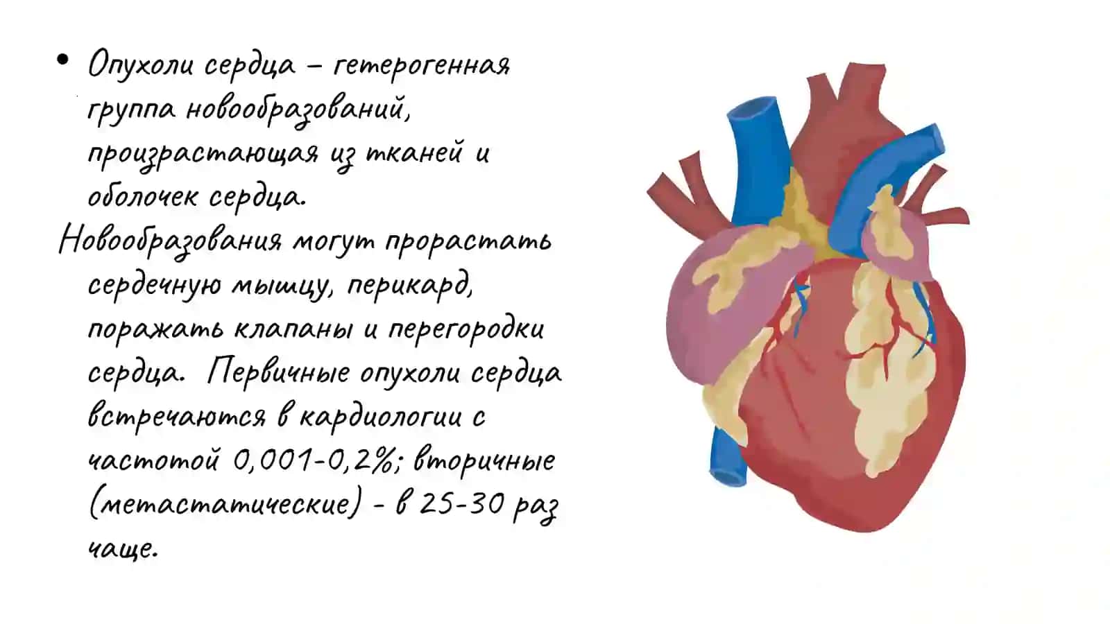 Опухоли сердца 2
