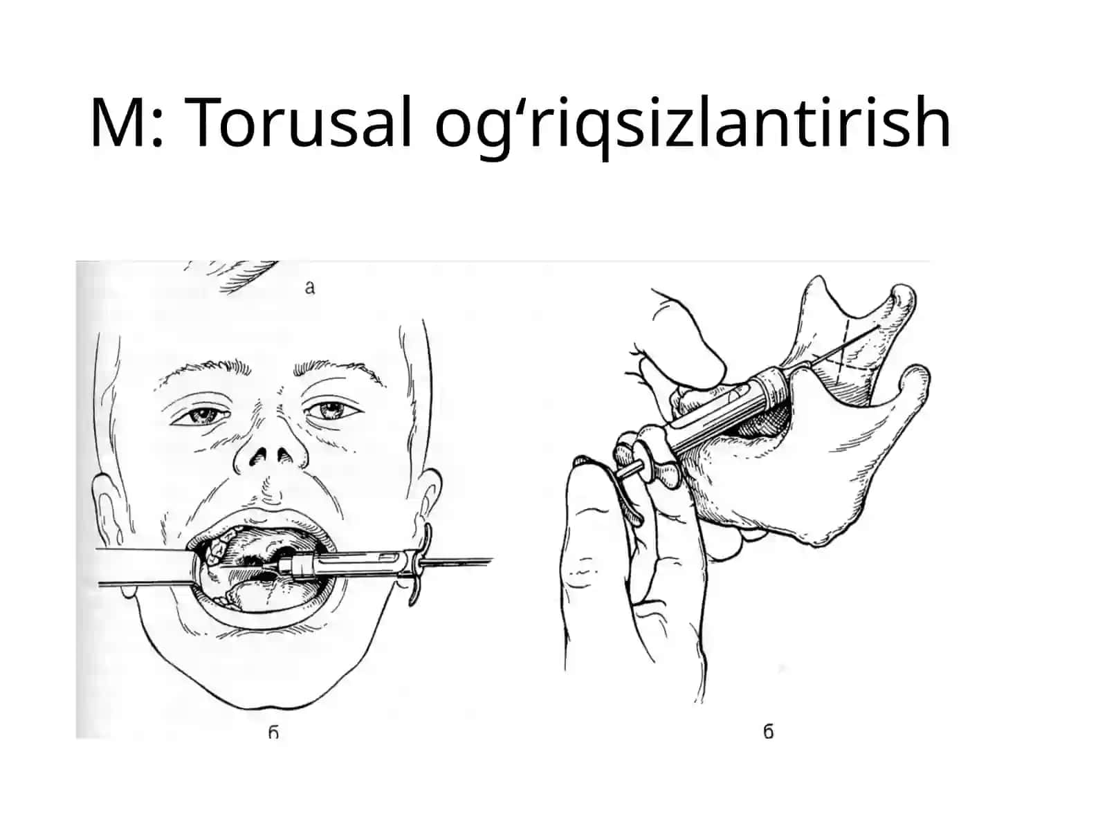 Torusal ogʻriqsizlantirish usuli 2