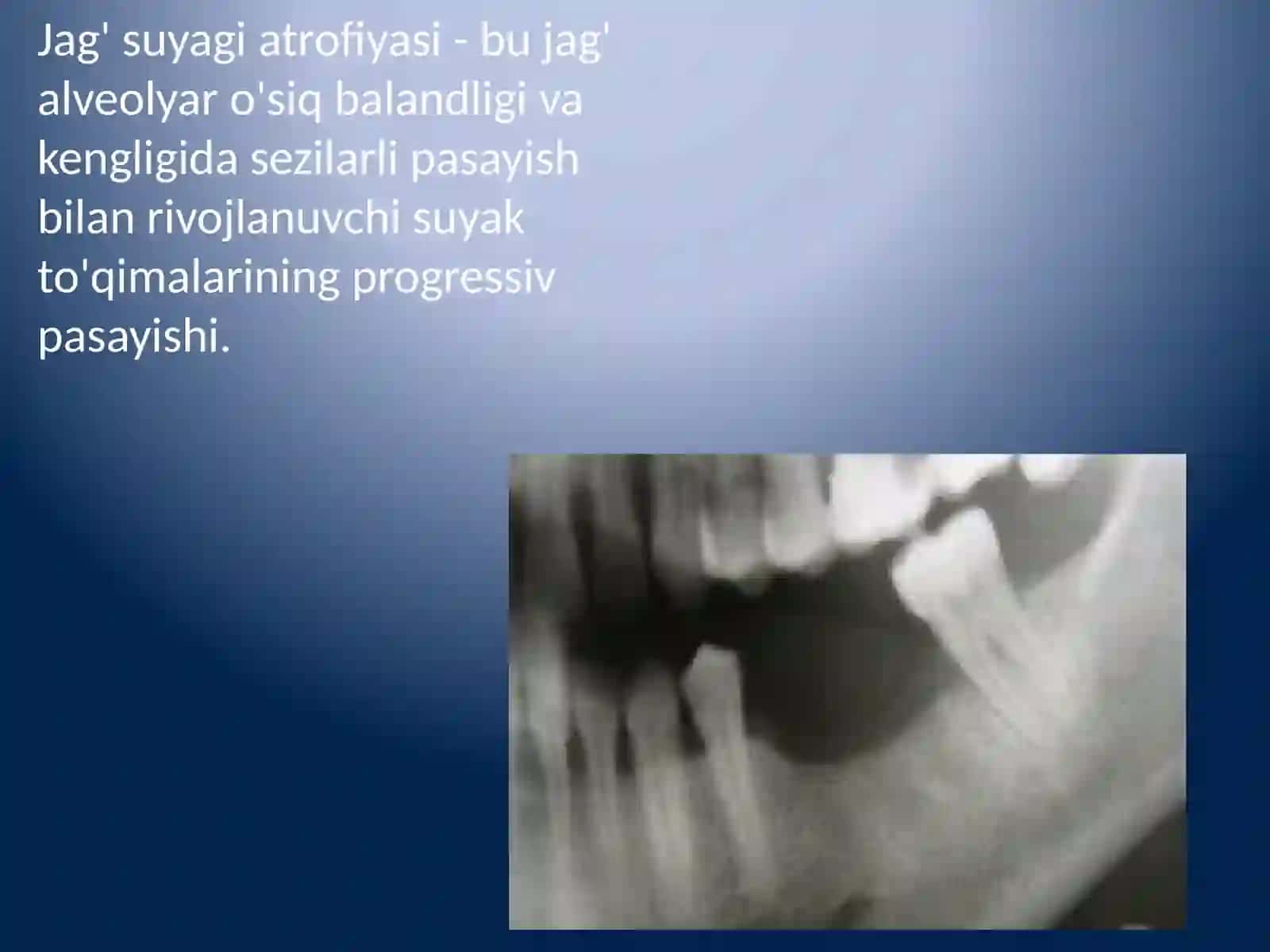 Jag' suyagi atrofiyasi 2