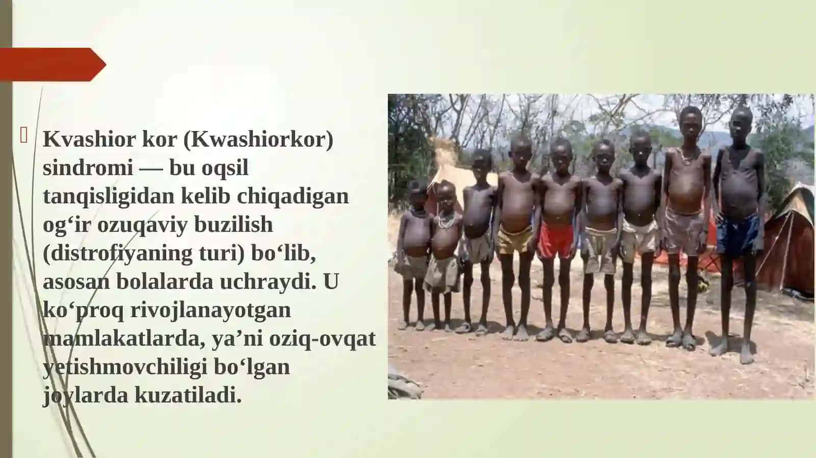 Kvashior sindiromi etiologiyasi patagenezi haqida. 2