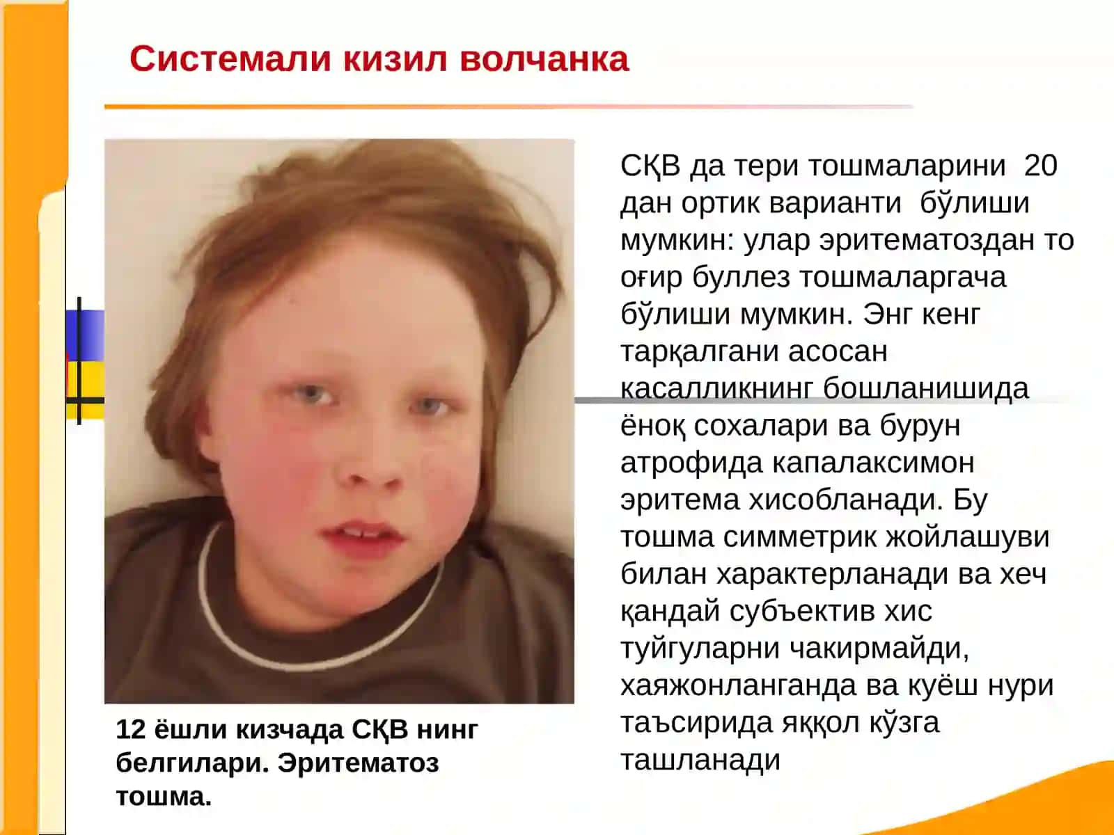 Системаликизил волчанка 2