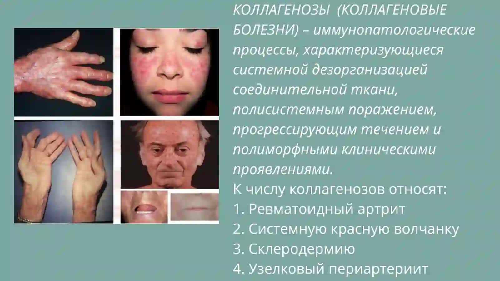 ОБСЛЕДОВАНИЕ БОЛЬНЫХ С КОЛЛАГЕНОЗАМИ 2