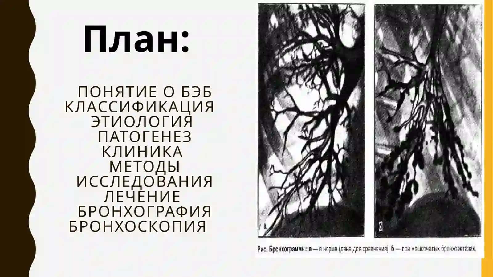Бронхоэктатическая болезнь 2