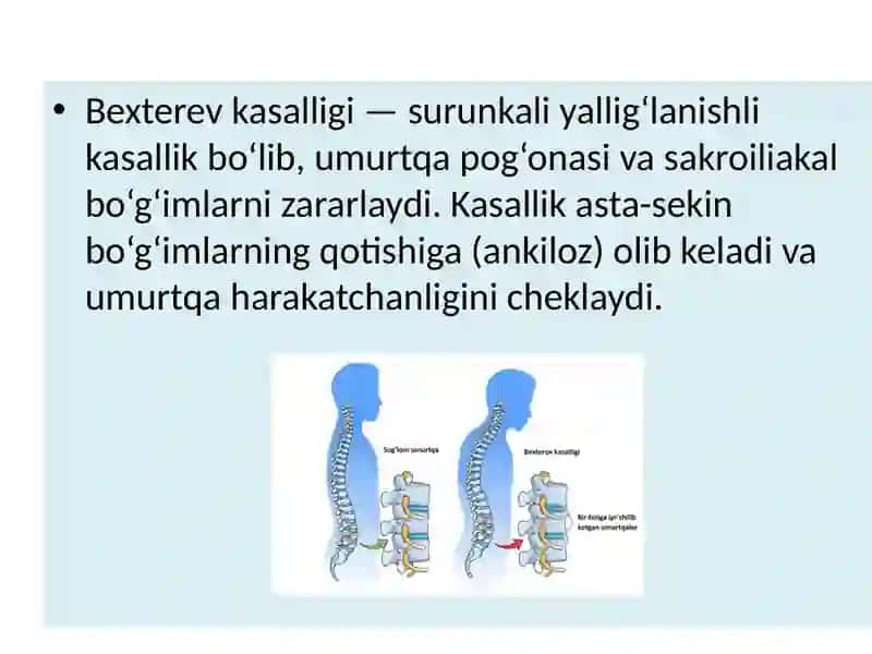 Bexterev kasalligi (ANKILOZLOVCHI SPONDILOARTRIT) 2