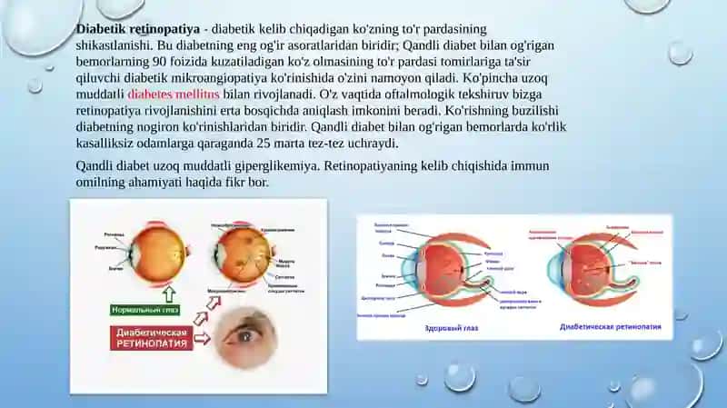 Diabetik retinopatiya 2