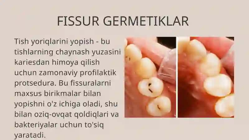 FISSUR GERMETIKLAR. QO'LLASH TEXNIKASi 2