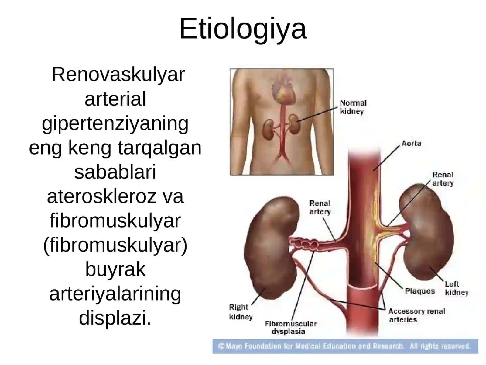 Renovaskulyar gipertenziya 2