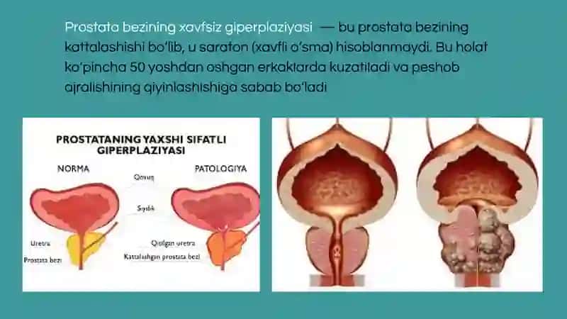 PROSTATA BEZI XAVFSIZ GIPERPLAZIYASI 2