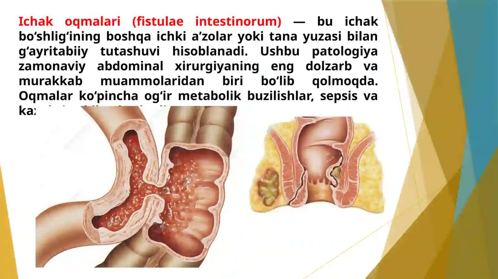 ICHAK OQMA YARALARINIBARTARAF QILISH USULLARI 2