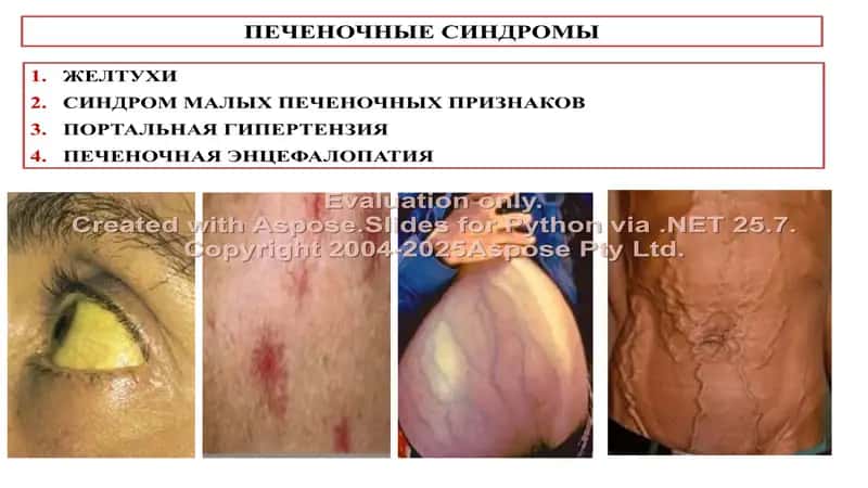 Желтуха (Icterus) 2