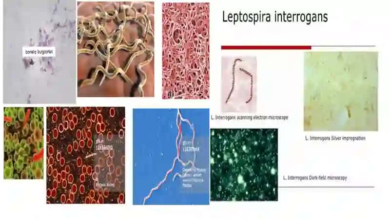 Borrelioz (Laym kasalligi) 2
