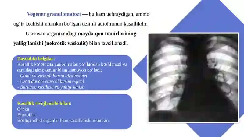 VEGENER GRANULEMATOZ 2