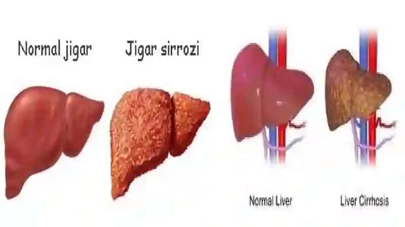 Jigar sirrozi 2