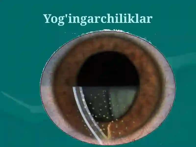 Ko'z kasalliklari 2