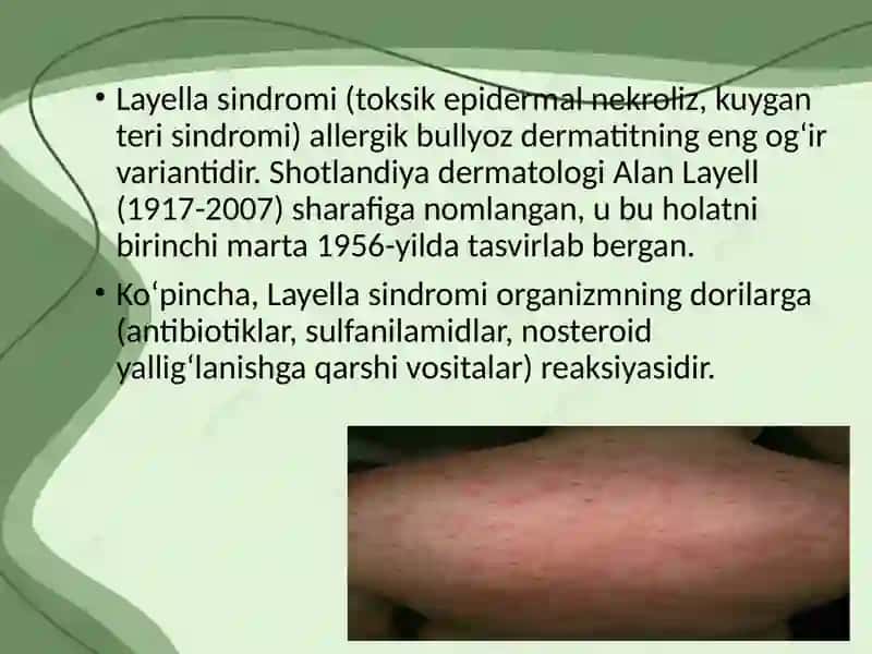 Layell va Stiven Djonson sindromlari 2