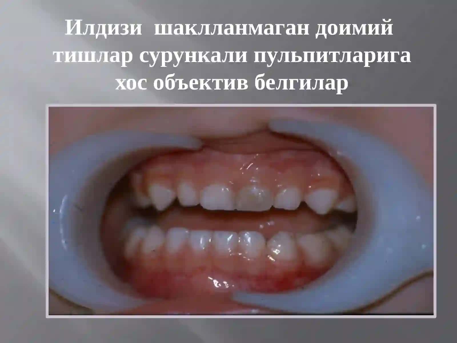 Илдизиш ақлланмаган доимий тишлар 2