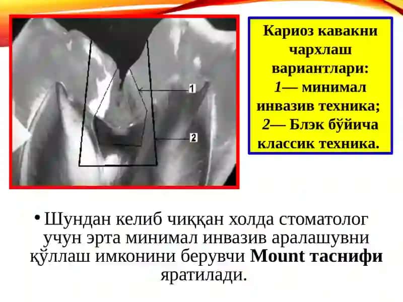 МИНИМАЛ ИНВАЗИВ ДАВОЛАШ 2