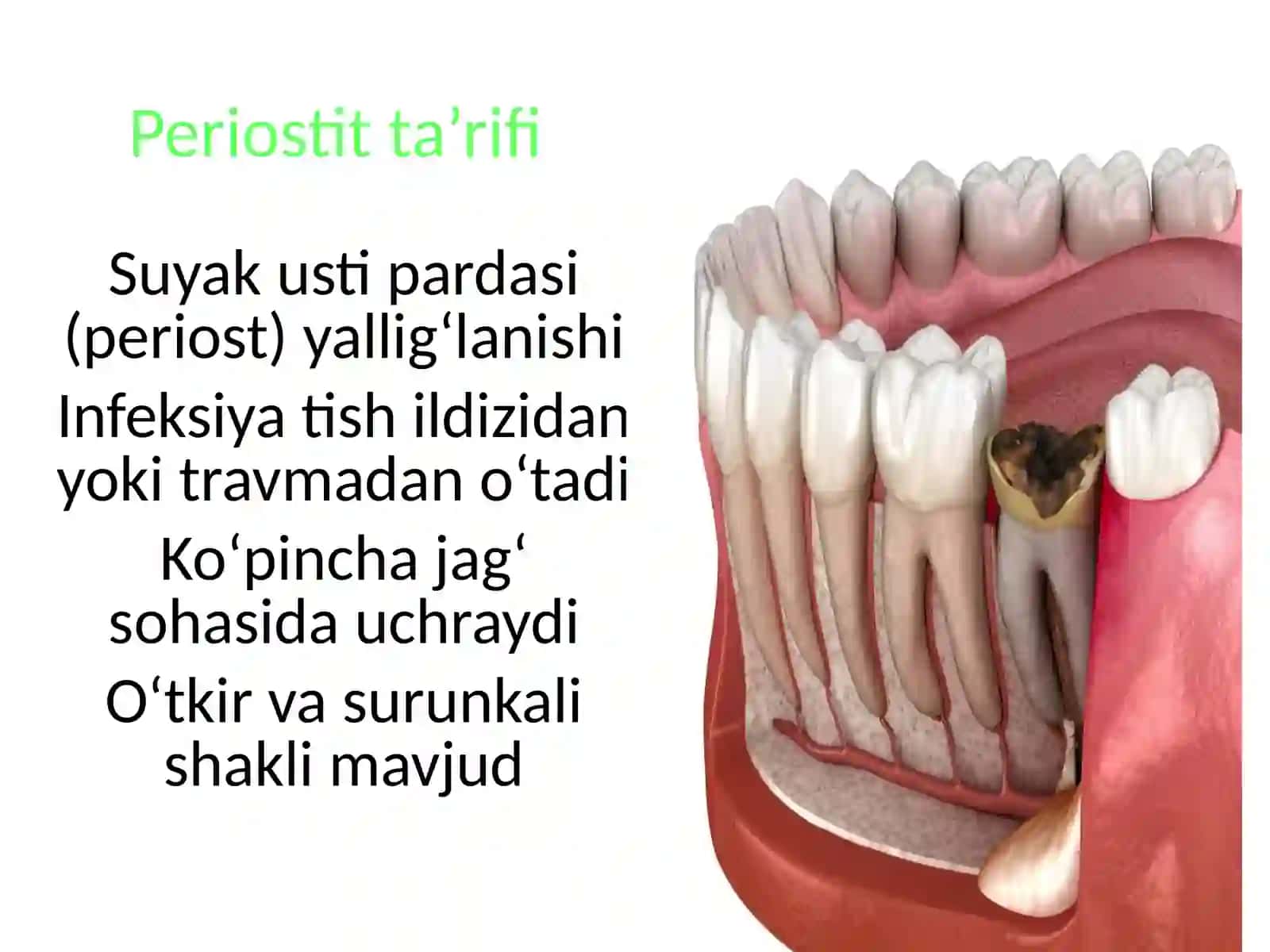 Periostit, abscessvaflegmona 2