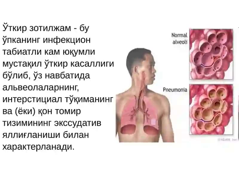 O’tkir zotiljam kasalligi 2