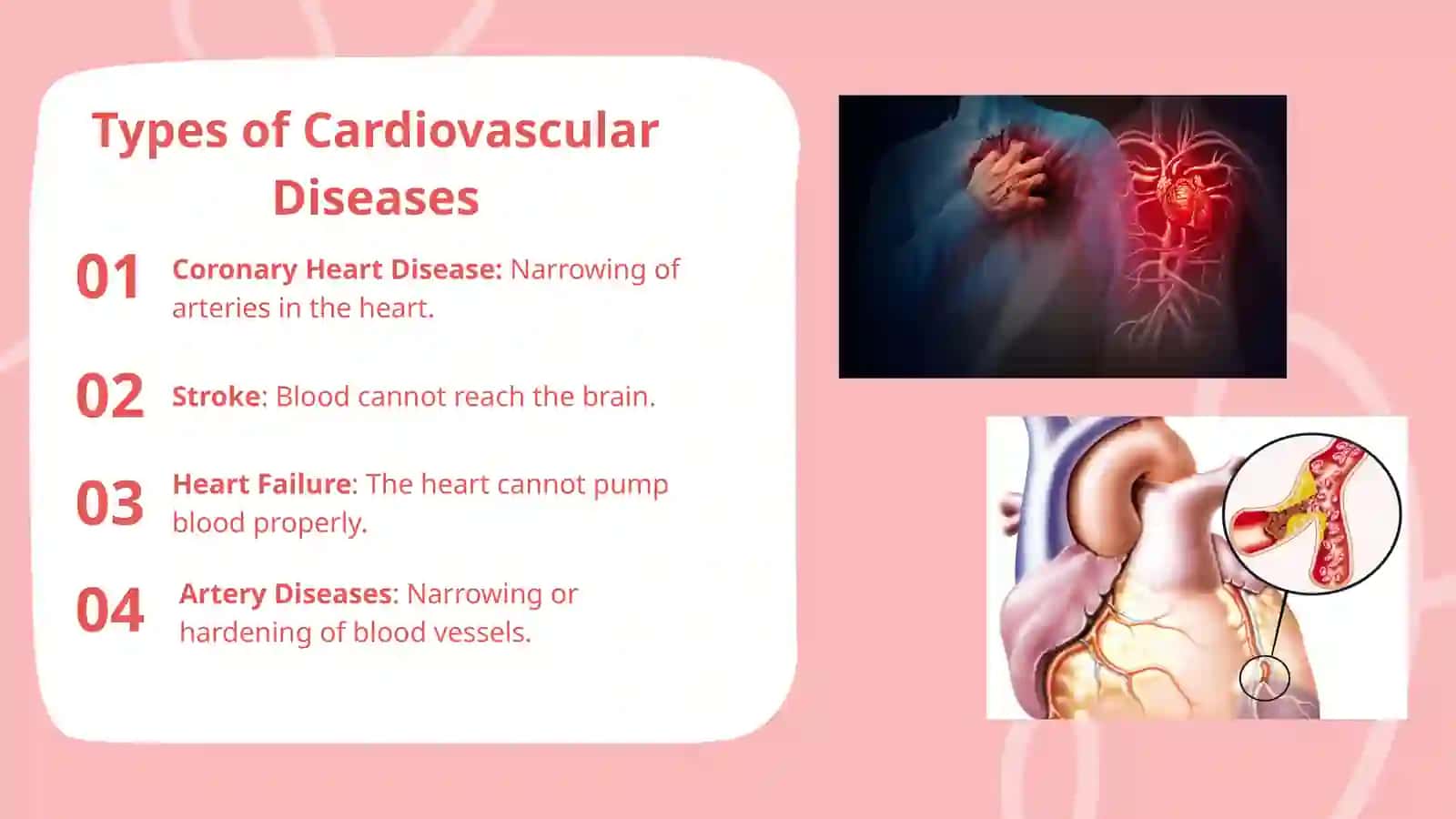 CARDIOVASCULAR DISEASE 2
