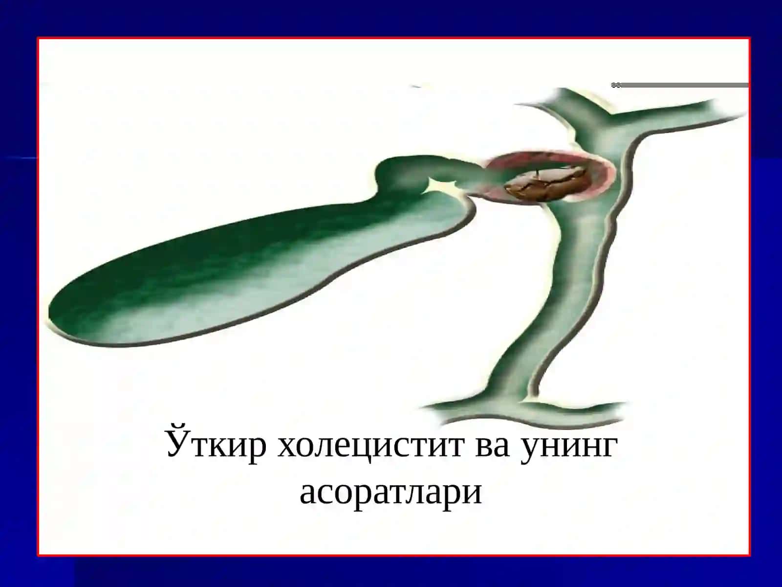ЎТКИР ХОЛЕЦИСТИТ ВА УНИНГ АСОРАТЛАРИ 2