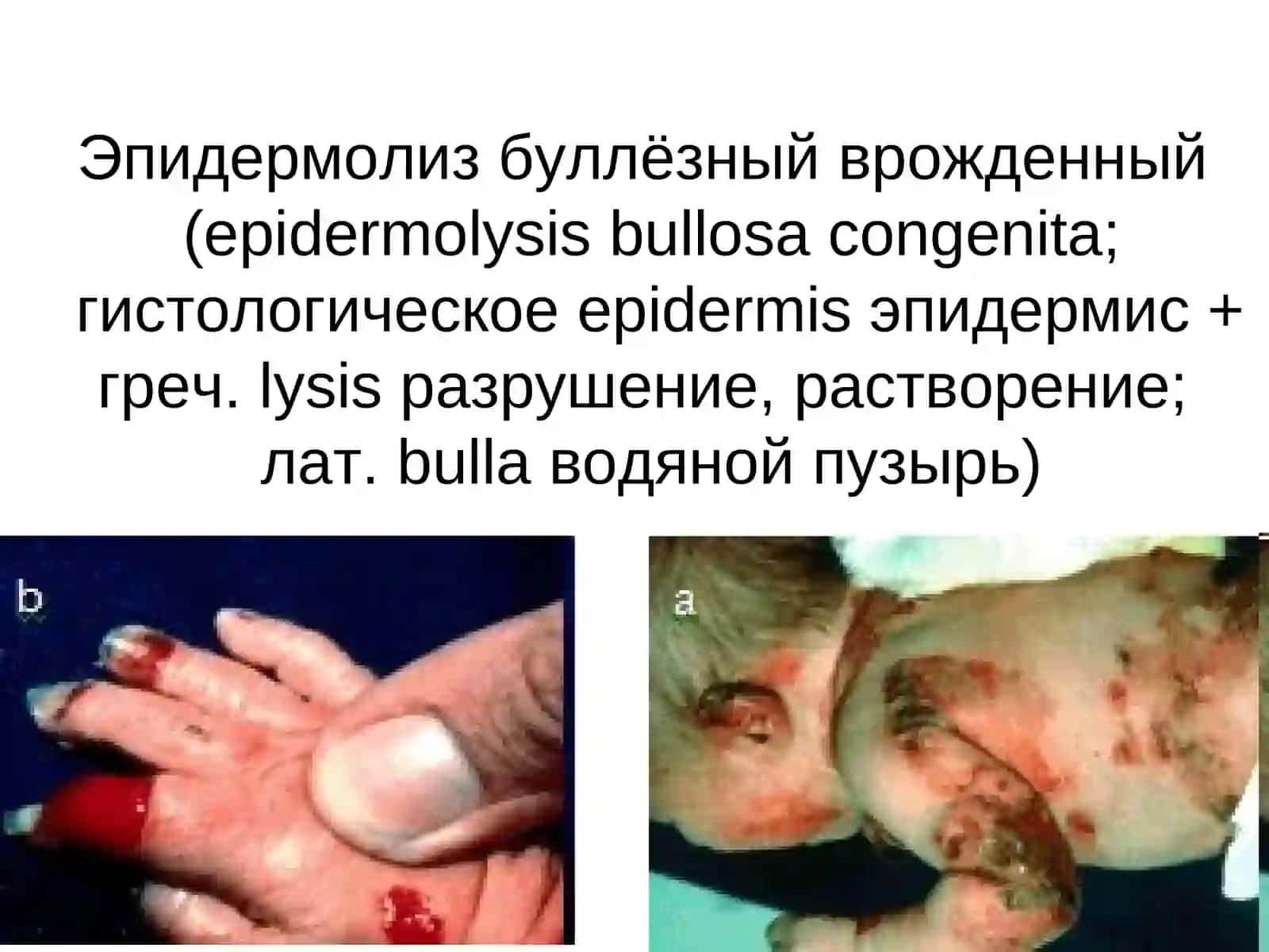 Эпидермолиз буллёзный врожденный 2