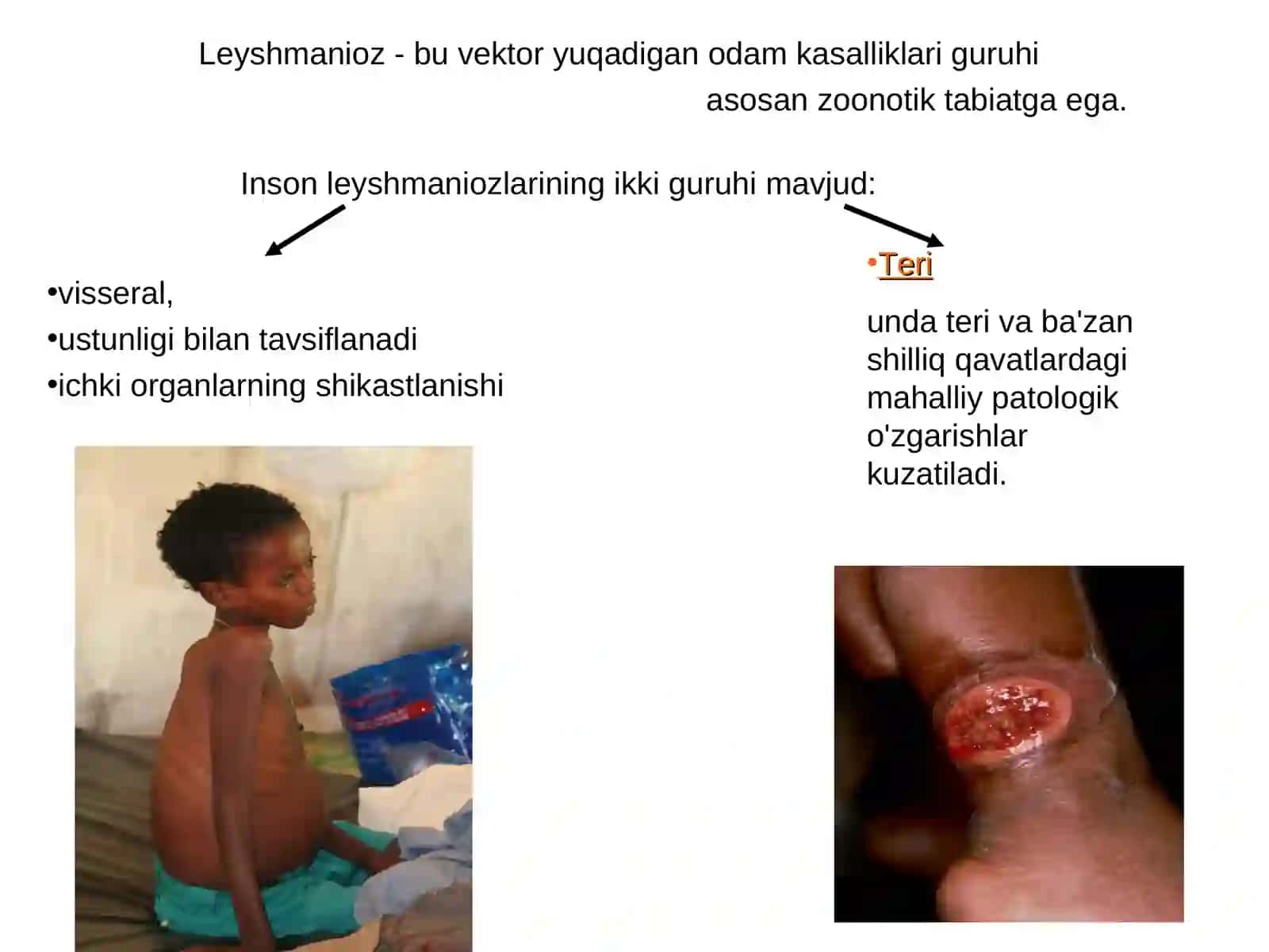 Parazitar infeksiyalar - Leyshmaniyoz 2
