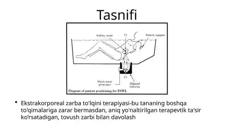 Ekstrakorporeal zarba to'lqini terapiyasi 2