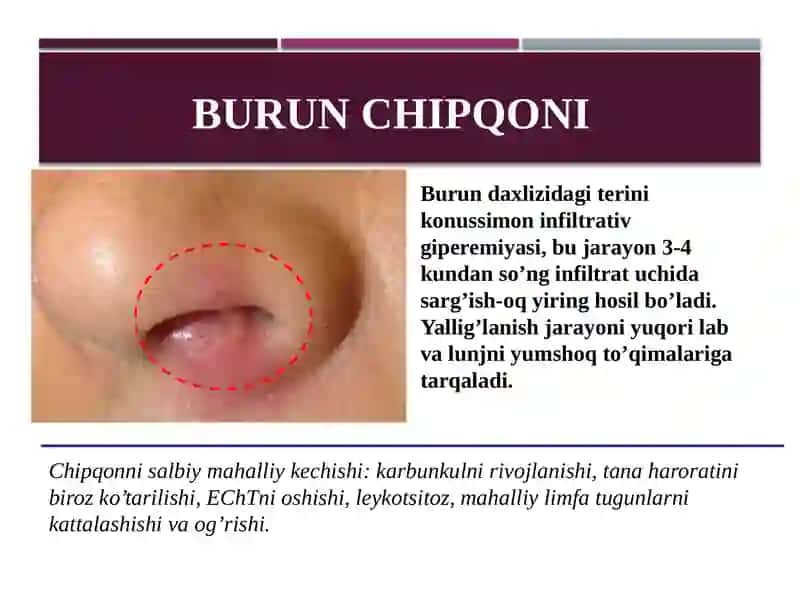 Burun chipqoni 2