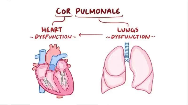 Cor pulmonale 2