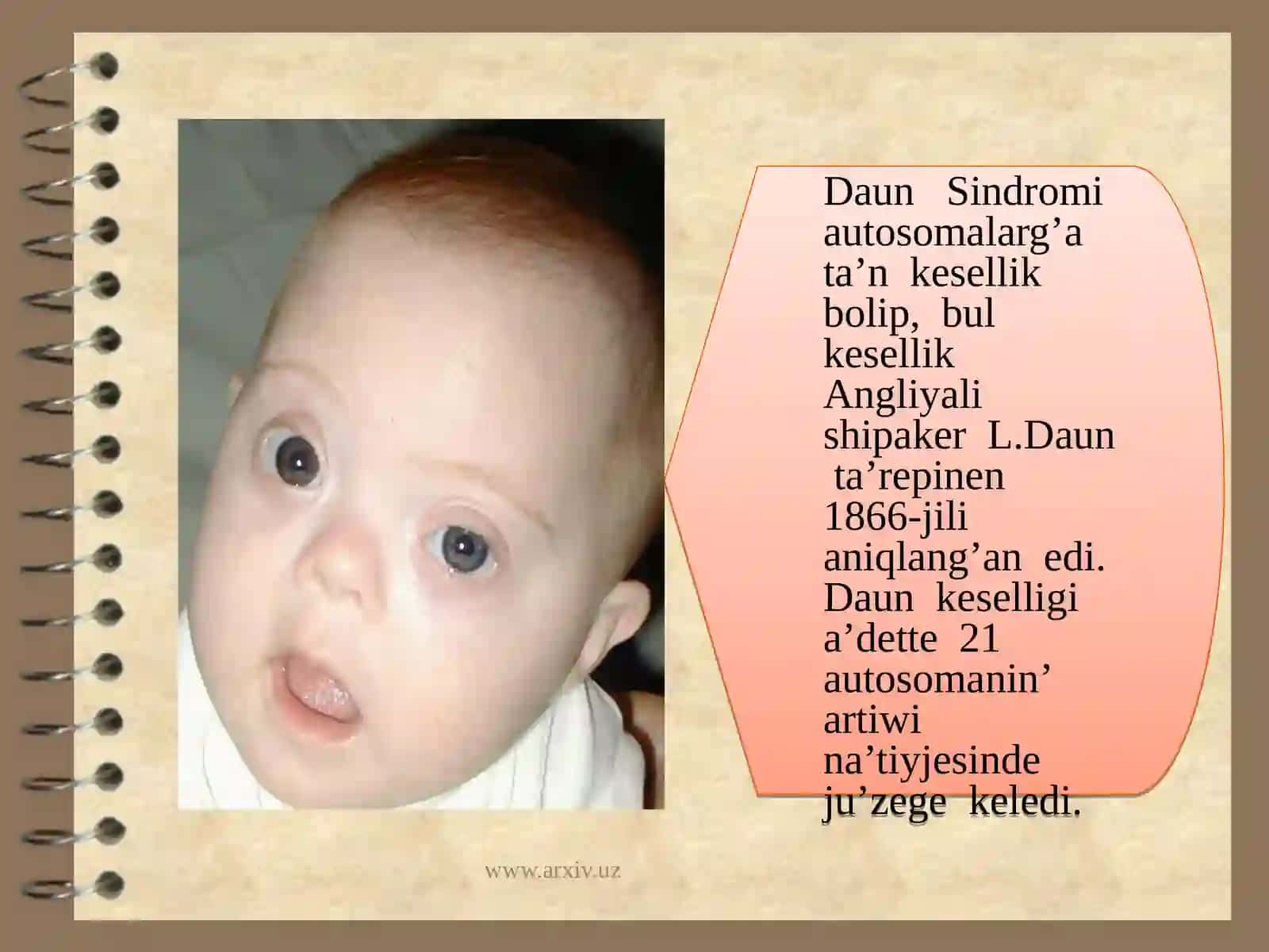 Xromosoma kesellikleri, Daun sindromi 2