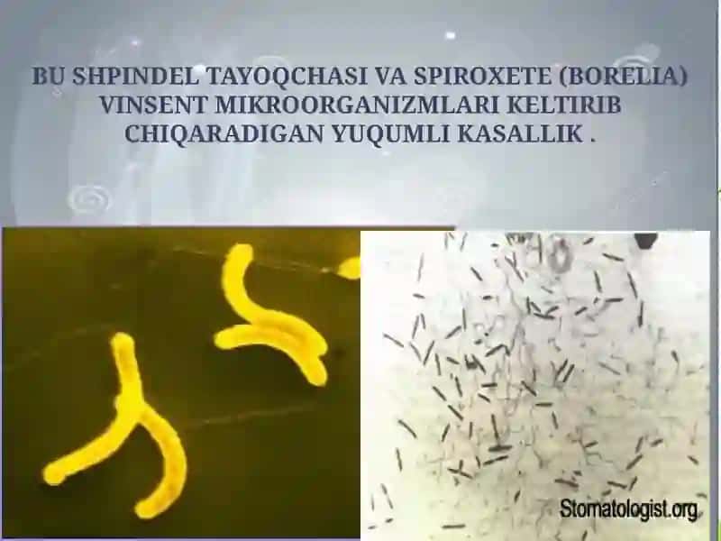 Vinsent Stomatiti 2