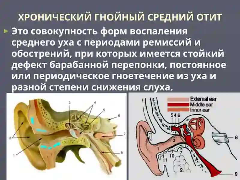 ХРОНИЧЕСКИЙ ГНОЙНЫЙ СРЕДНИЙ ОТИТ 2