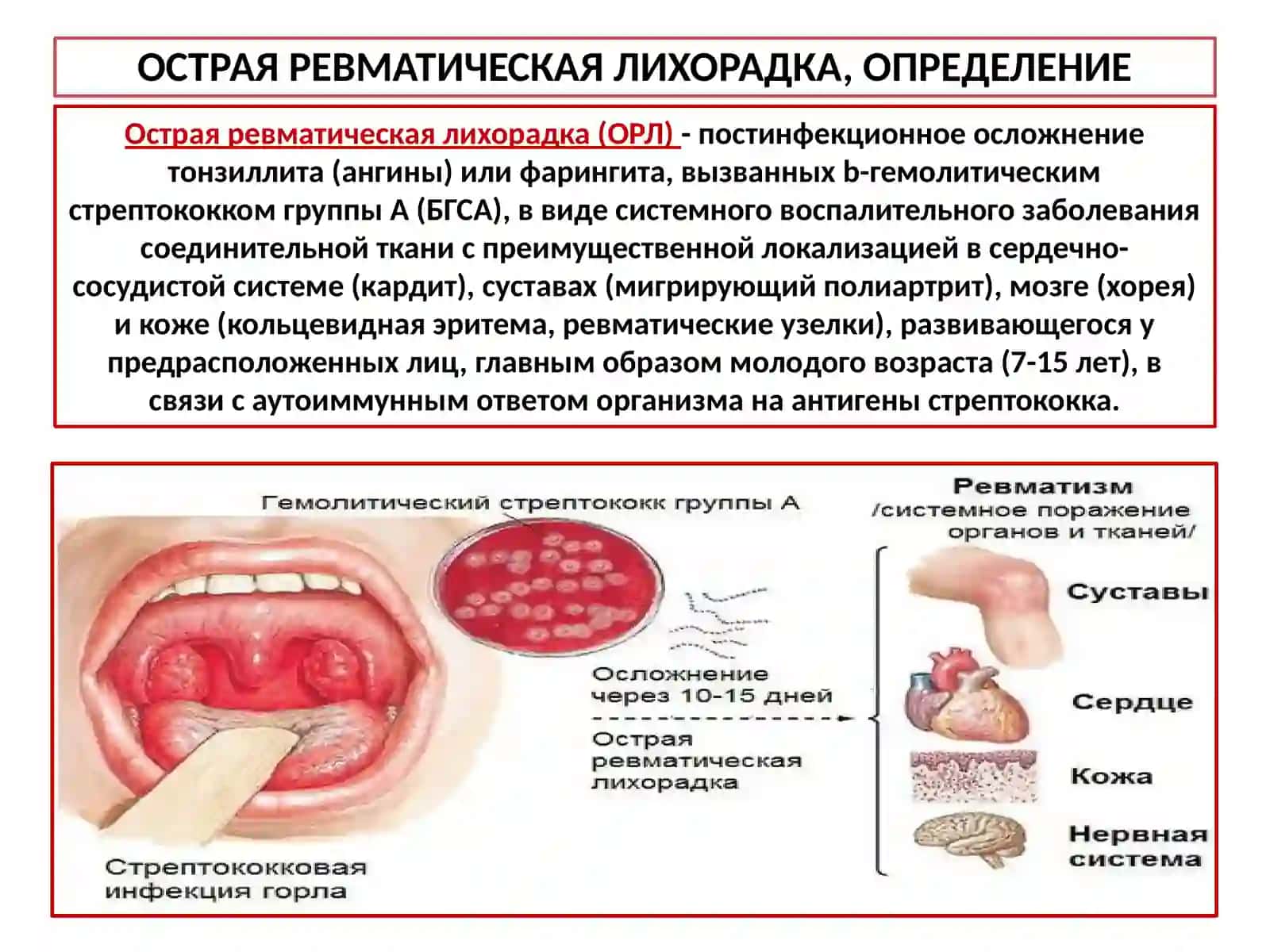 Острая ревматическая лихорадка, определение 2