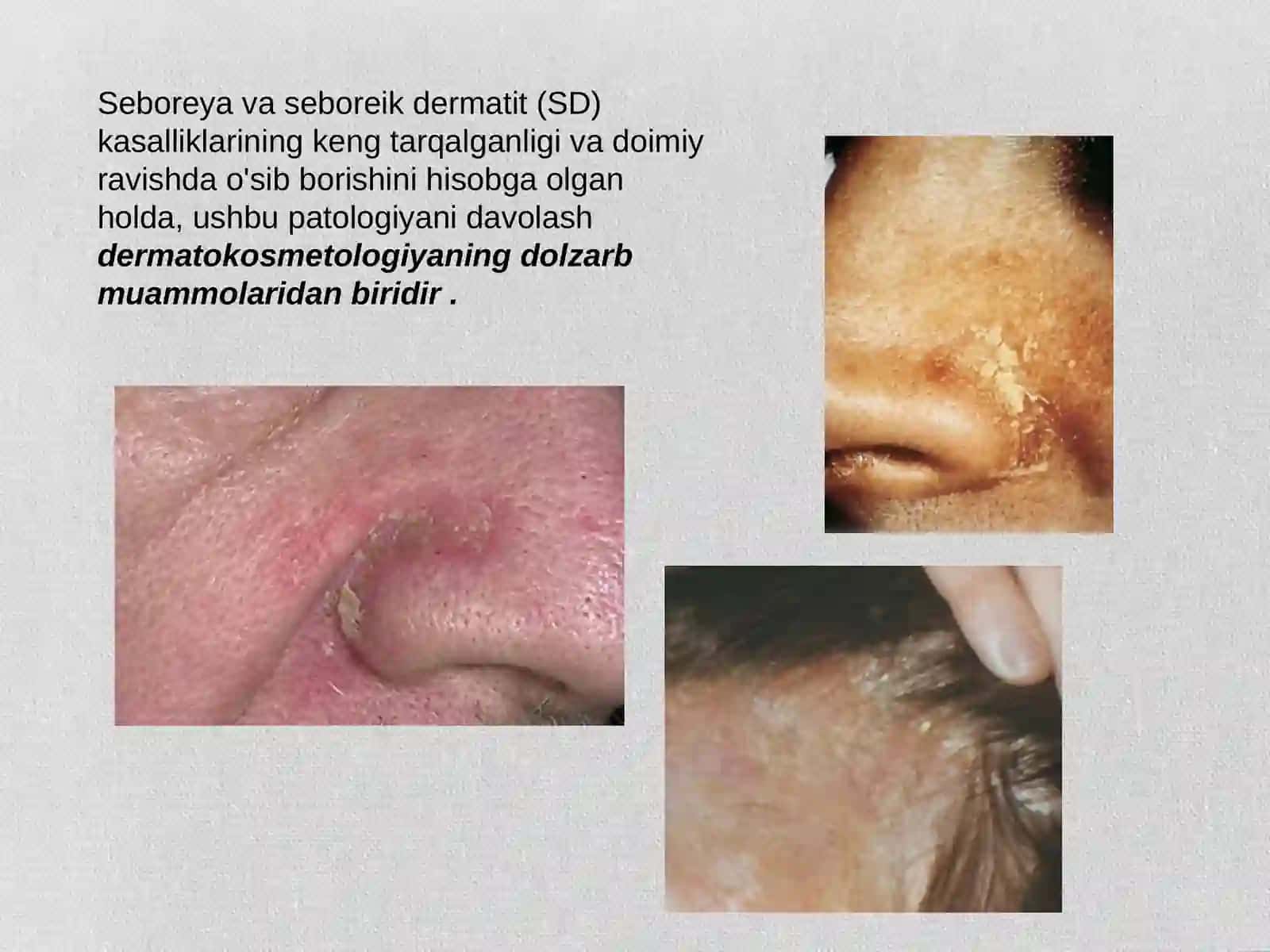 Seboriya va seboreik dermatit (SD) 2