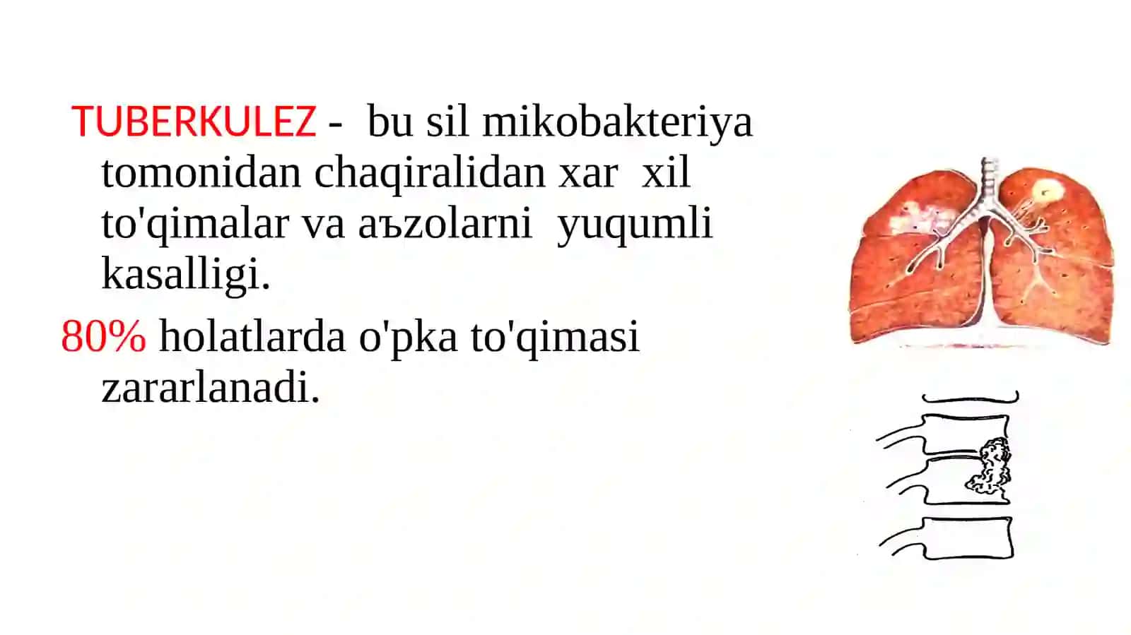 Tuberkulez 2