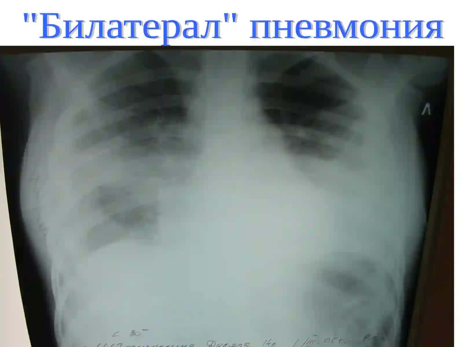 Чап томонлама плеврит 2