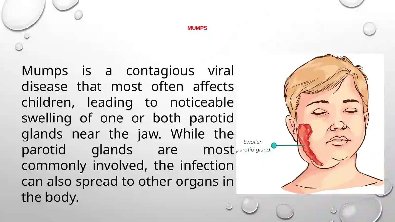 Mumps 2