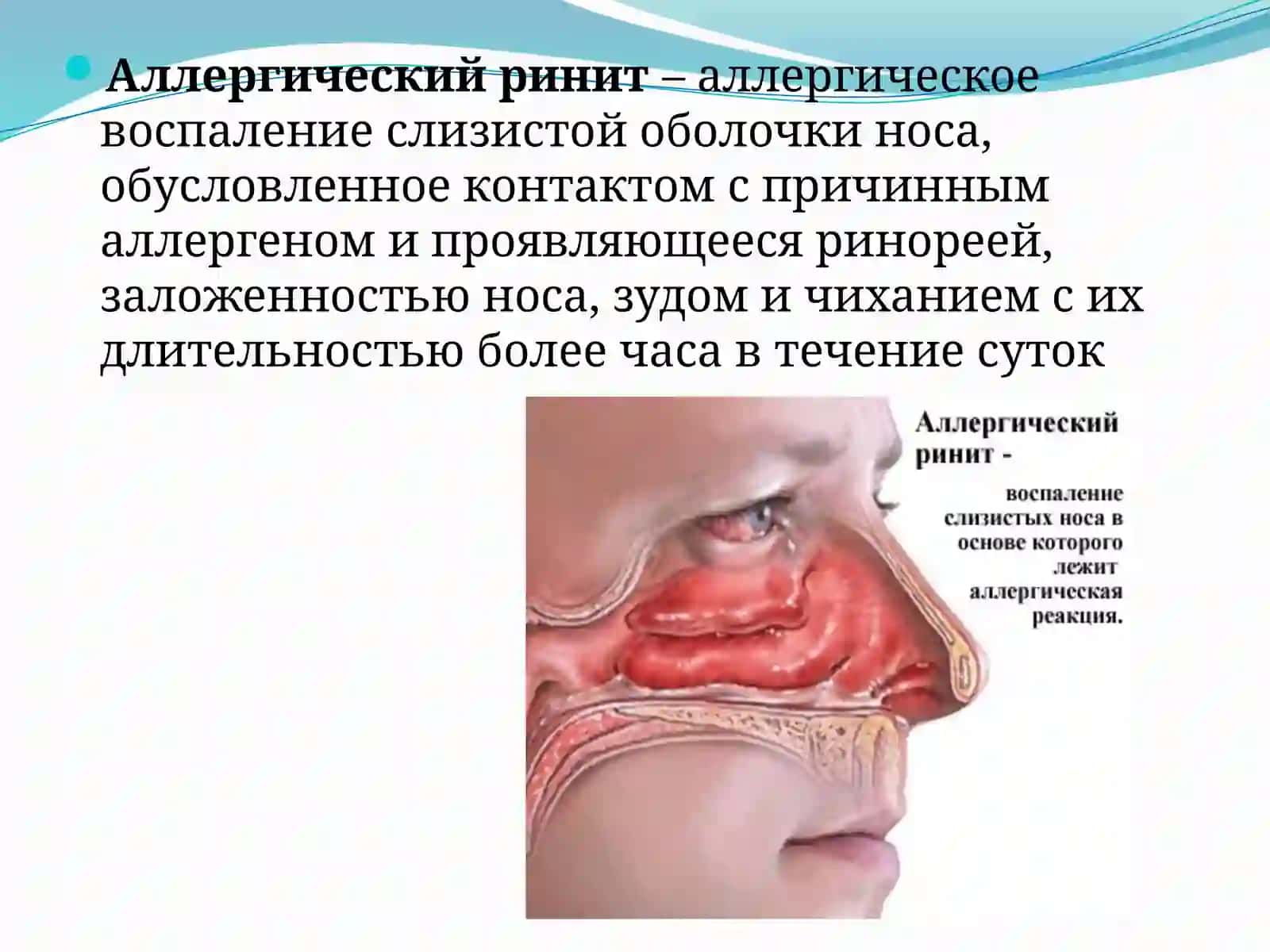 Аллергический ринит 2