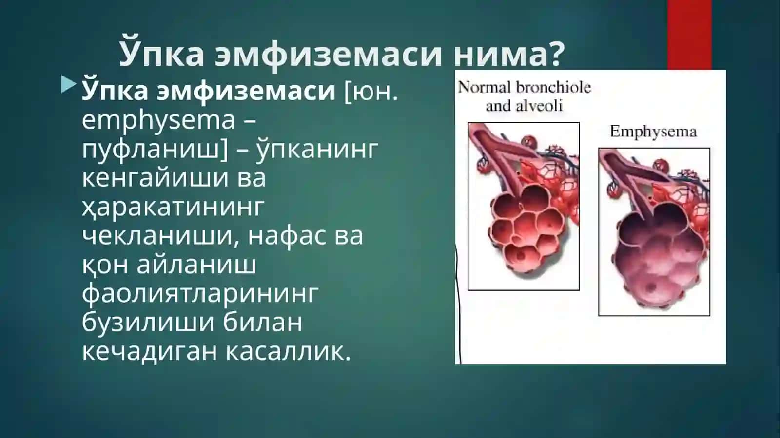 Ўпка эмфиземаси (o'ka emfuzemasi) 2