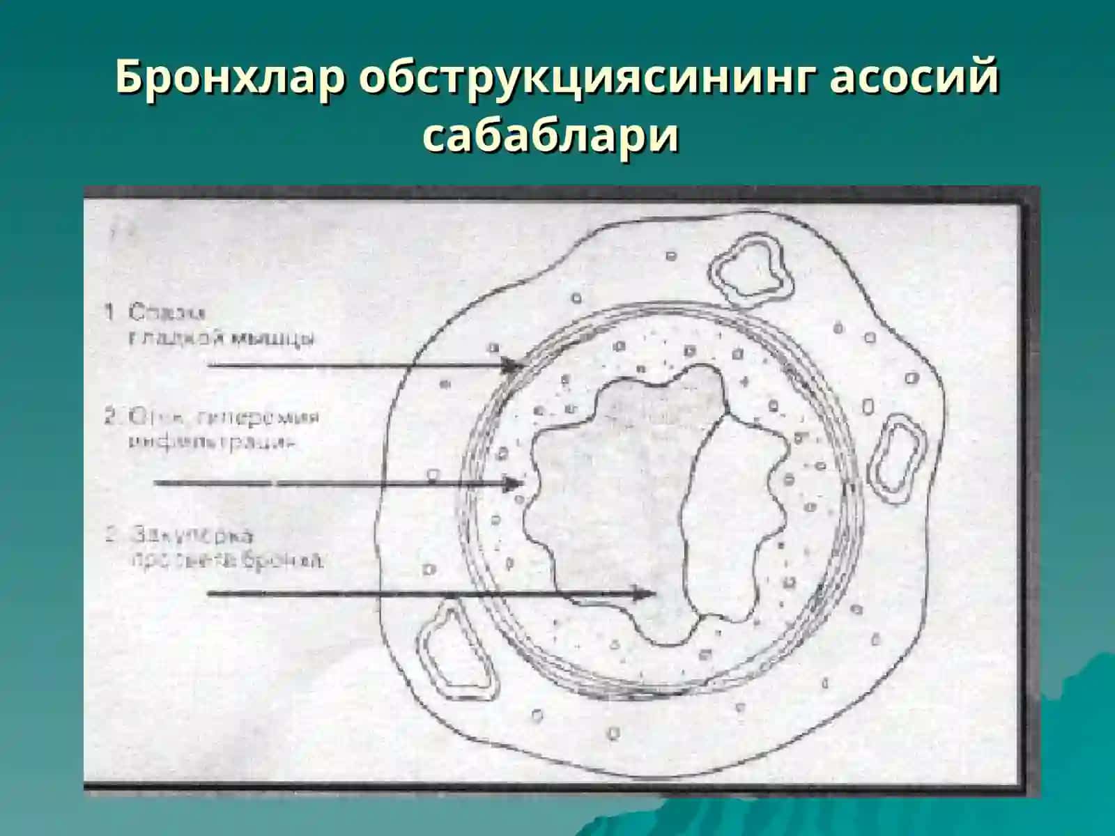Бронхлар обструкцияси синдроми:бронхиал астма 2